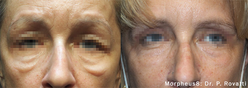 morpheus8 skin tightening soho nyc